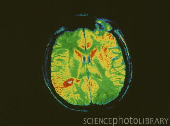 Imagen de resonancia magnética del cerebro coloreada